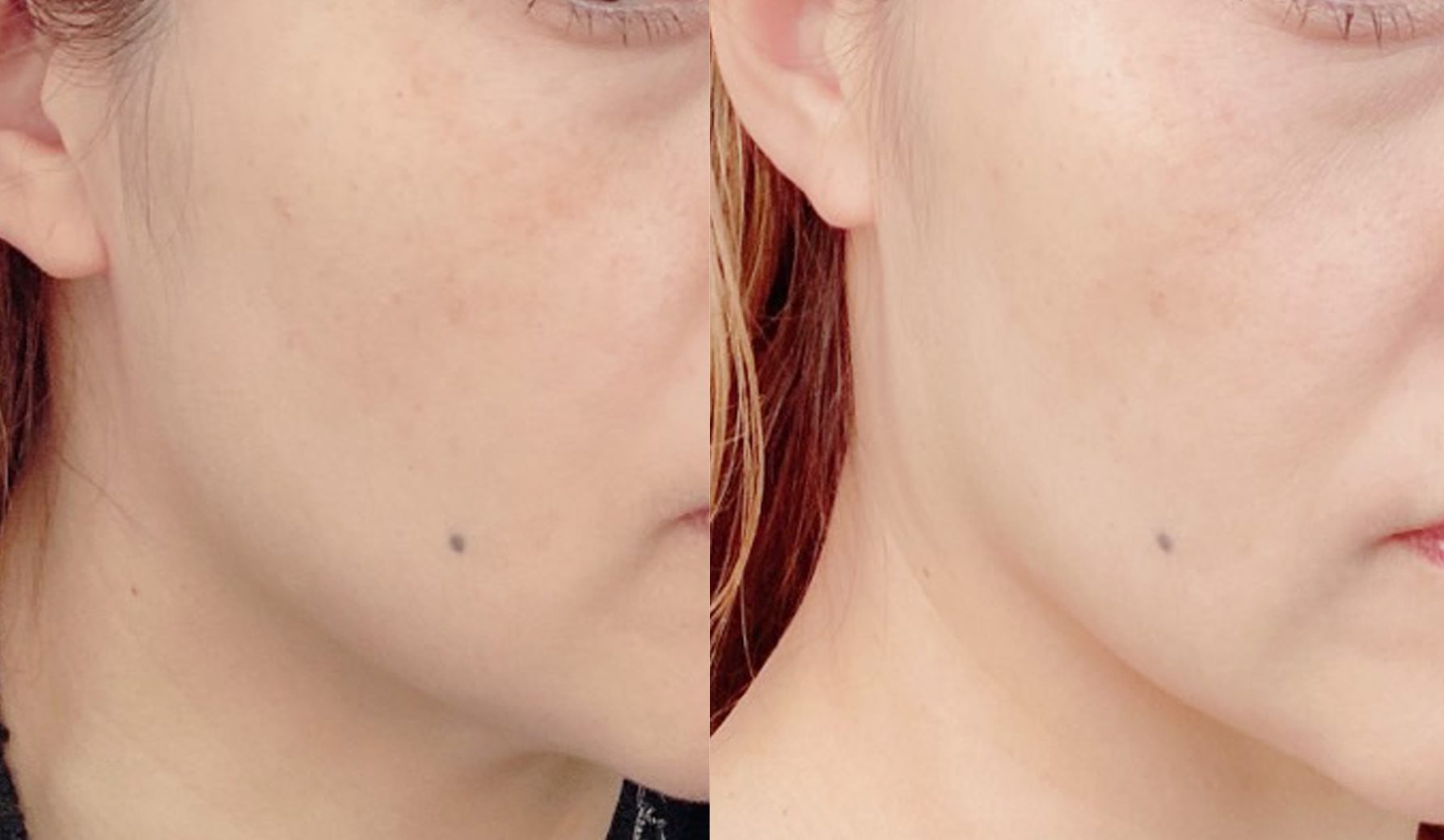 左：使用前。顔の下半分はローションを塗るとしみるほど乾燥でゴワゴワ。しぼんだ印象の肌でした。
右：使用後。水分をたたえたしっとり肌に！ くすんでいた肌色も少し明るくなった気がします
